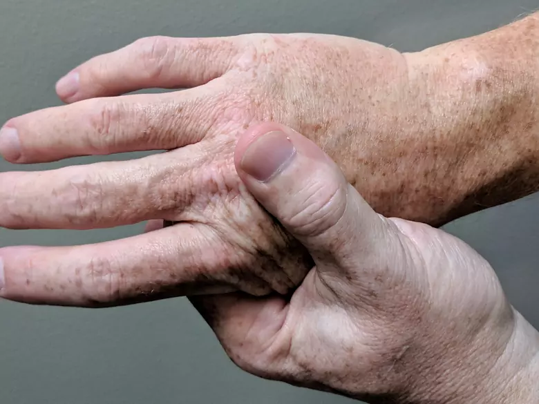 Comment faire face aux problèmes d'arthrite ?