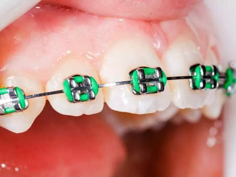 Le recul des gencives est-il dangereux ?