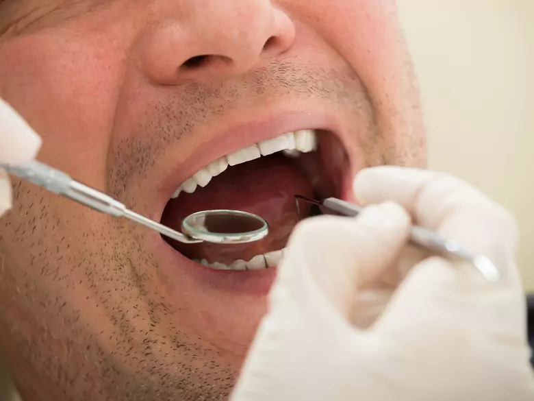 Traitement des dents sans foret
