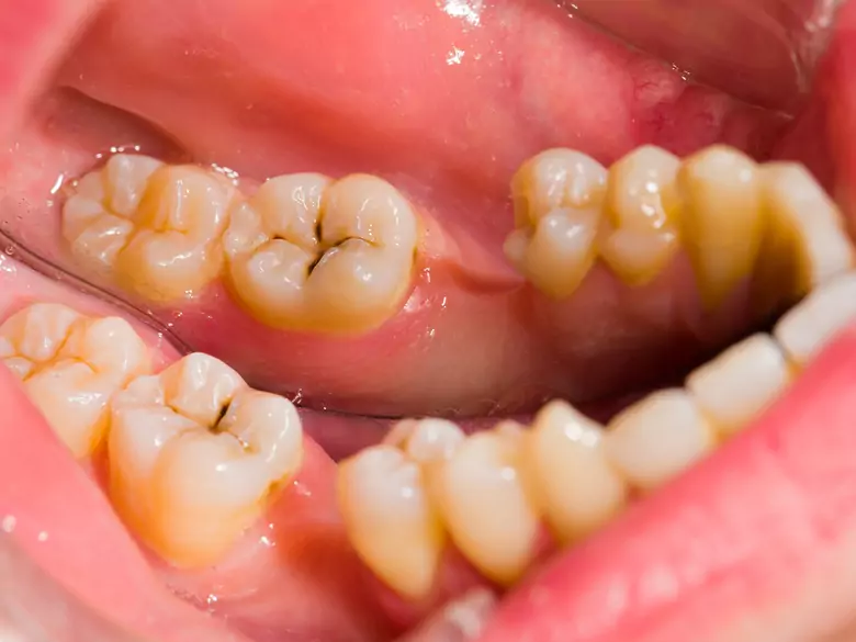 Facteurs de risque des caries