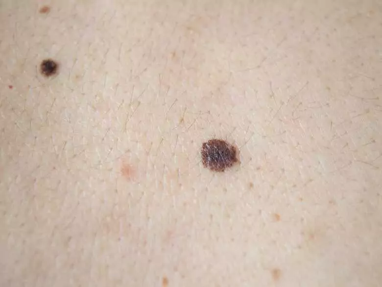 Auto-examen de la peau : pourquoi le faire et que faut-il craindre ?