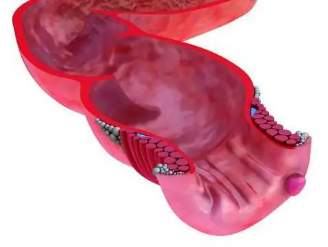 Formation et développement d'un thrombus - thrombose veineuse profonde