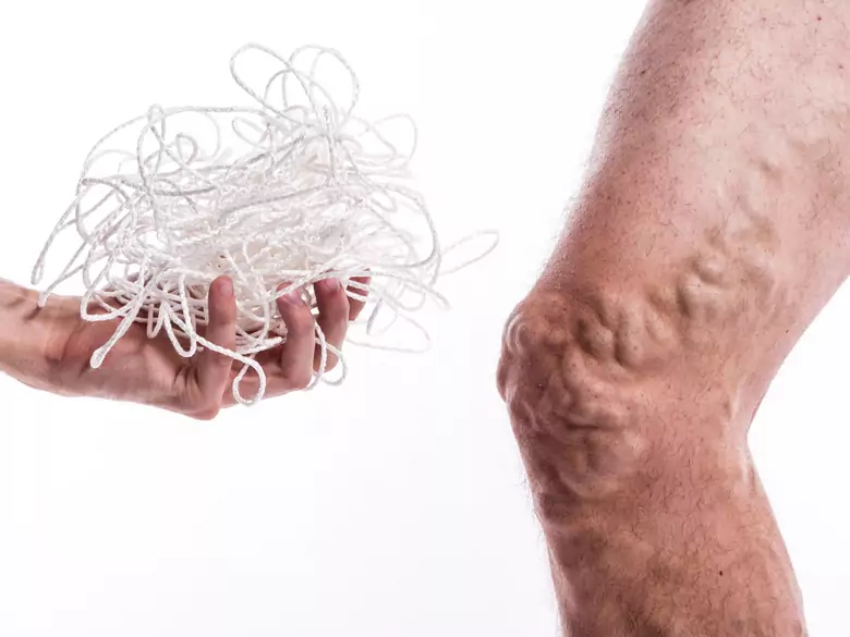 Comment traiter les problèmes de varices ?