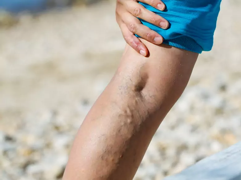 Comment traiter les problèmes de varices ?